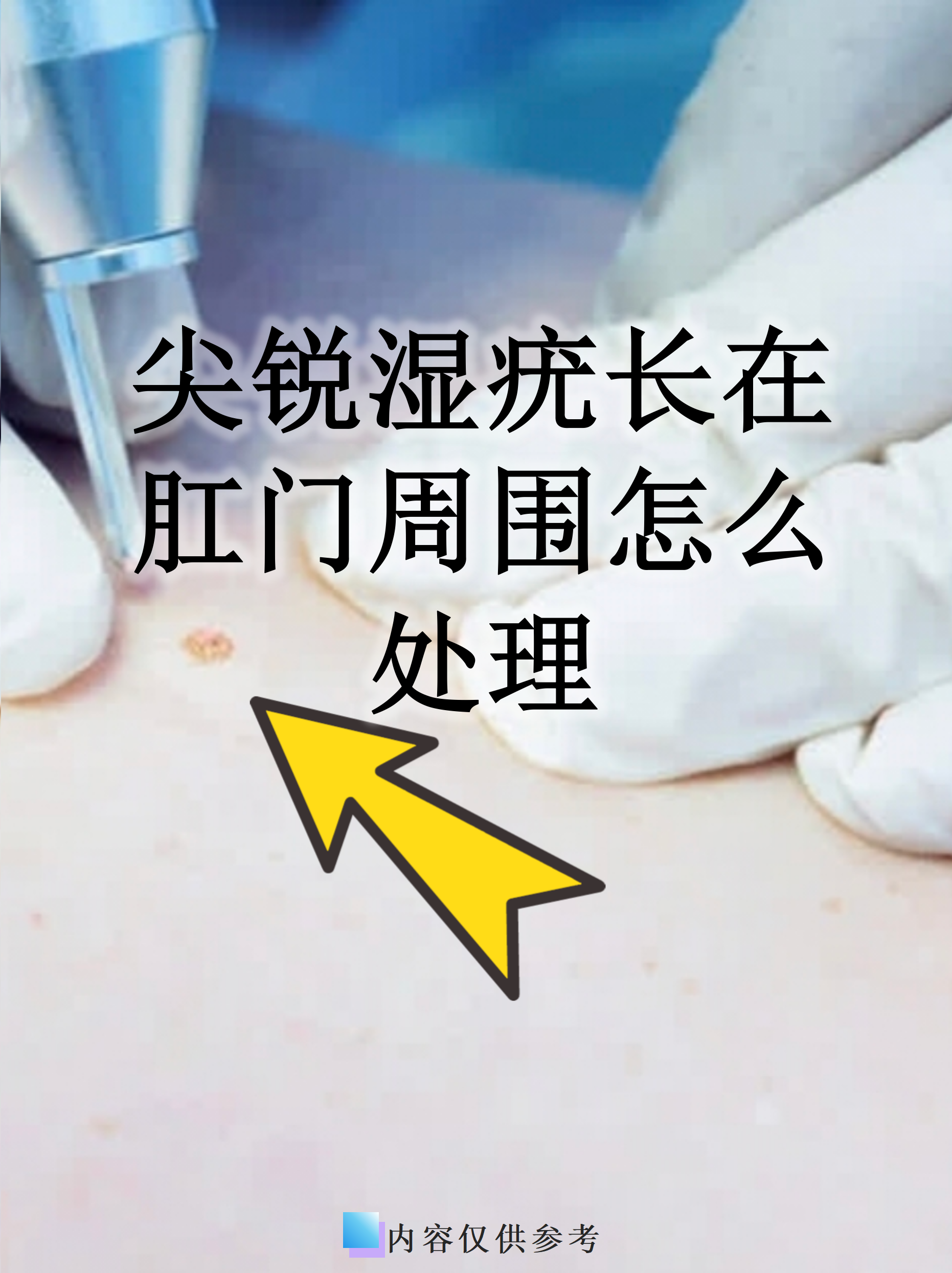 尖锐湿疣怎么治疗才能根治好治吗_(尖锐湿疣治疗最佳办法) 尖锐湿疣怎么治疗才能根治好治吗_(尖锐湿疣治疗最佳办法)