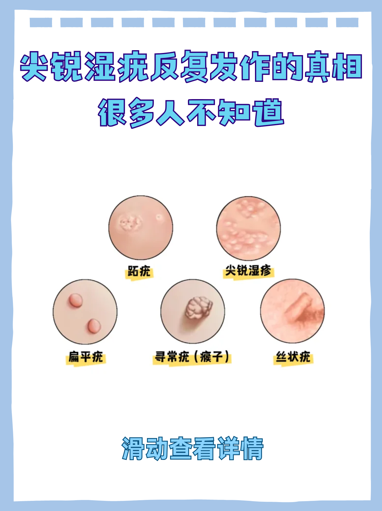 尖锐湿疣怎么治疗才能根治不传染_(尖锐湿疣怎么治疗才能根治不传染家人) 尖锐湿疣怎么治疗才能根治不传染_(尖锐湿疣怎么治疗才能根治不传染家人)